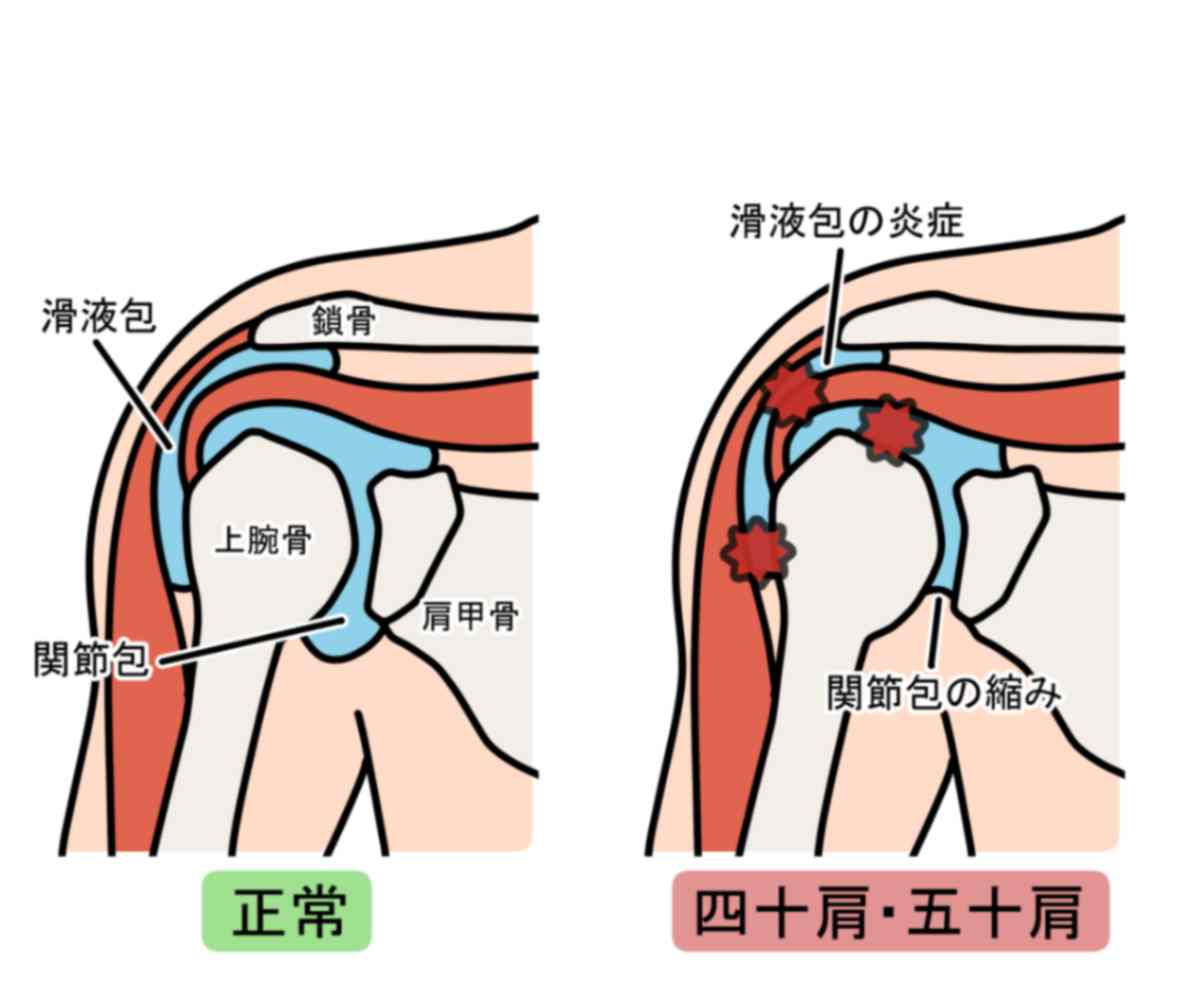 四十肩のメカニズム