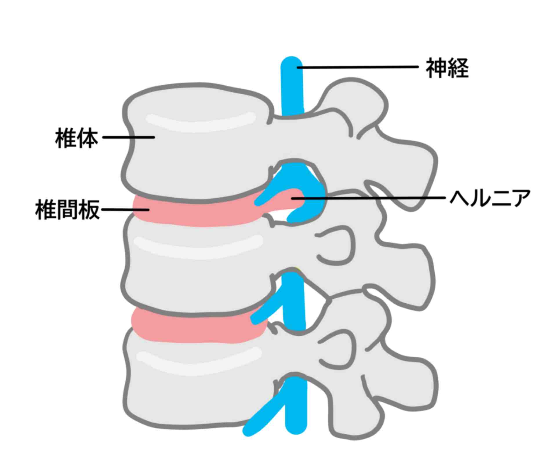 当整骨院による坐骨神経痛の施術