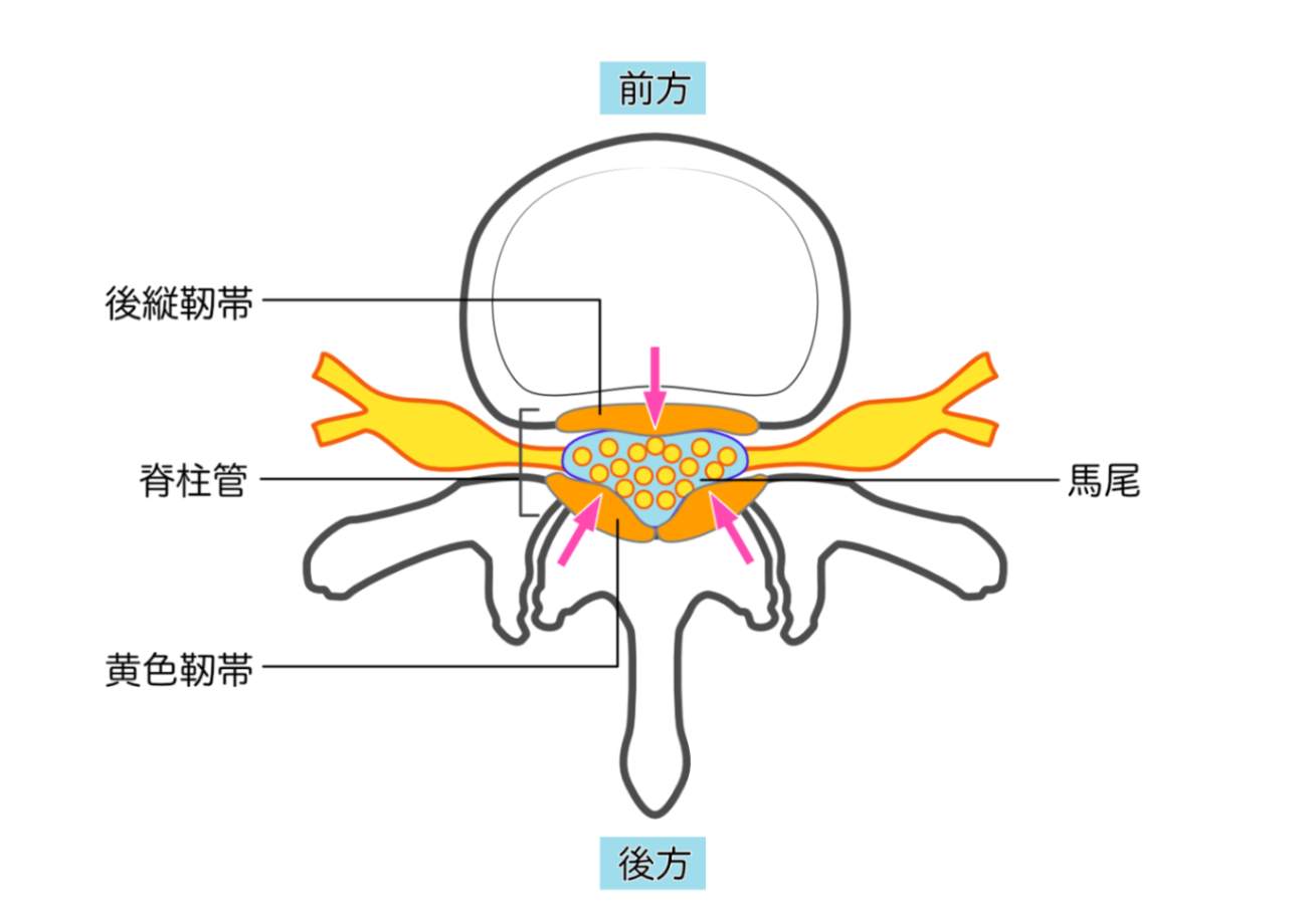 頚椎脊柱管狭窄症の原因