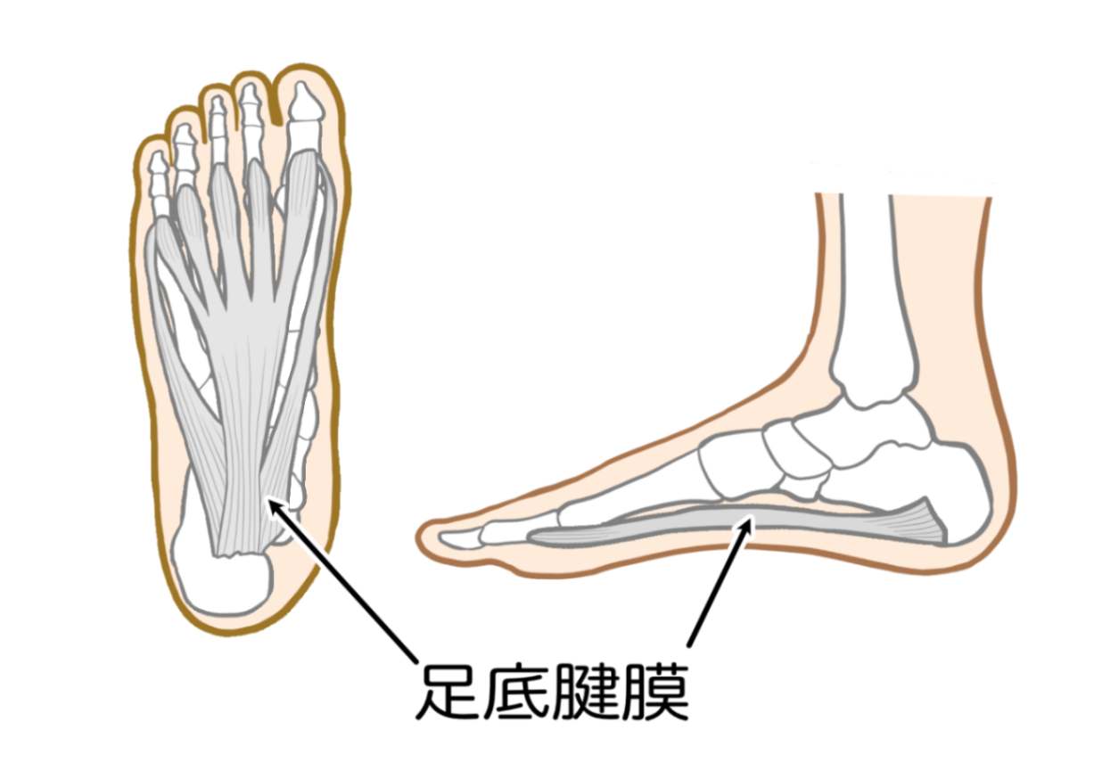 足底筋膜炎が考えられる症状