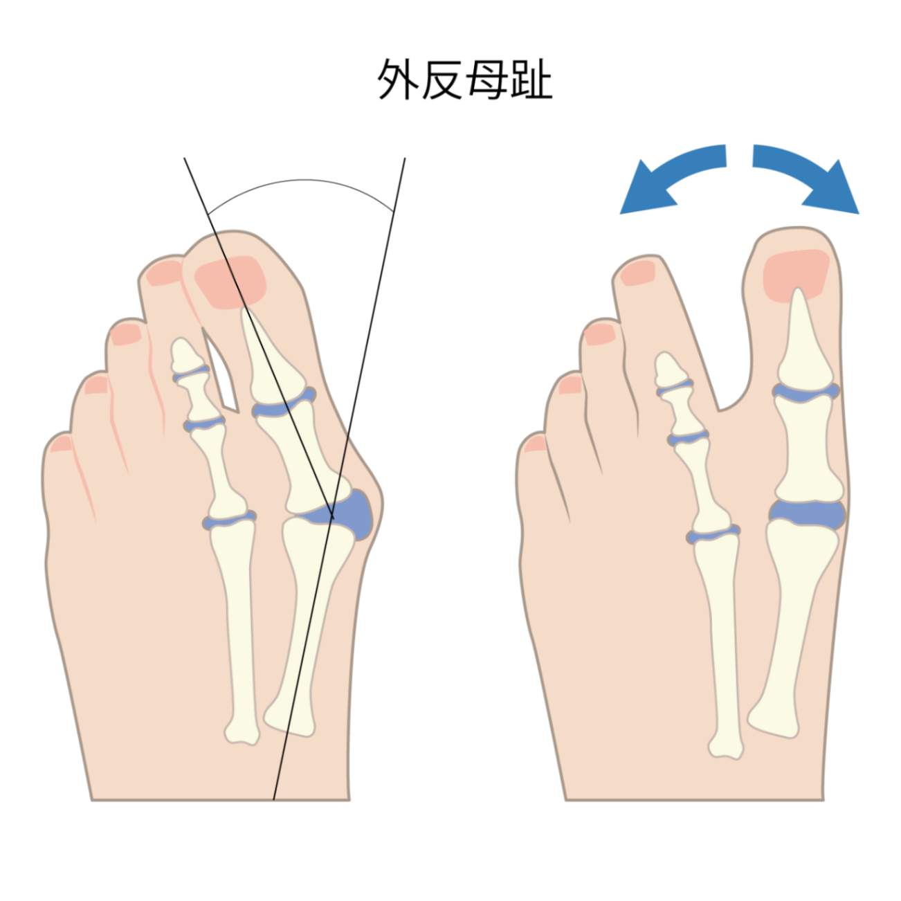 外反母趾が考えられる症状