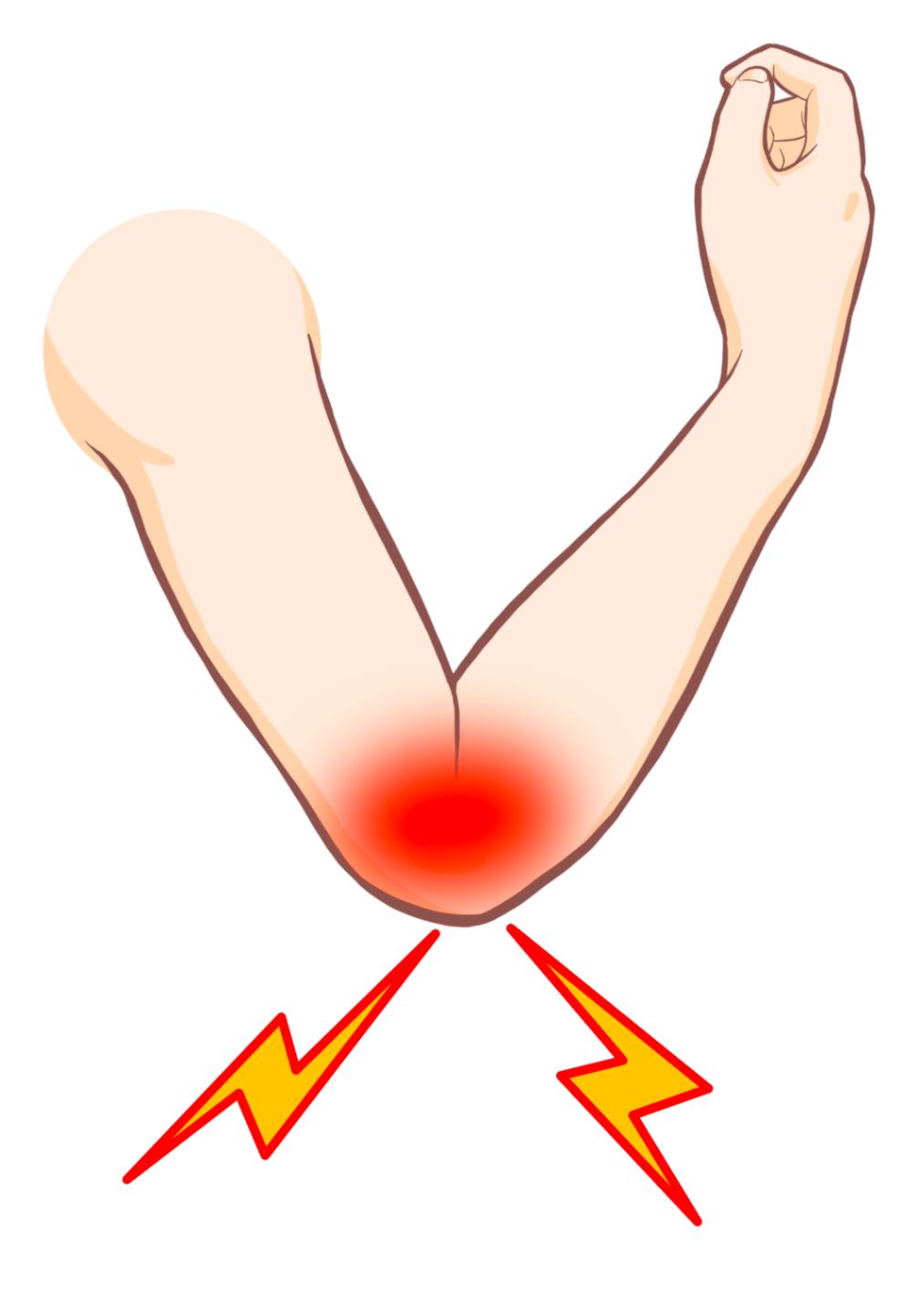 テニス肘の疑いがかかる症状