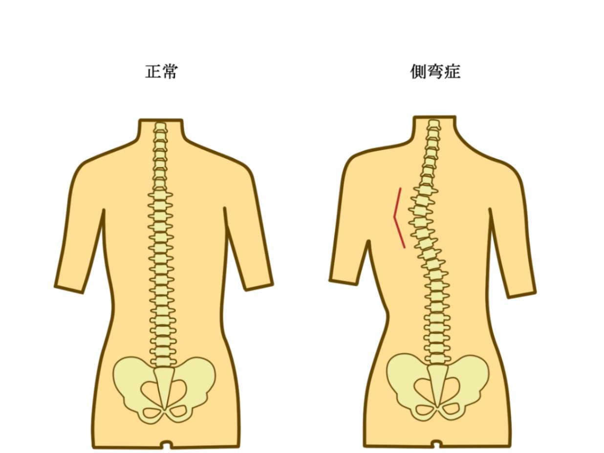 脊柱側弯症とは