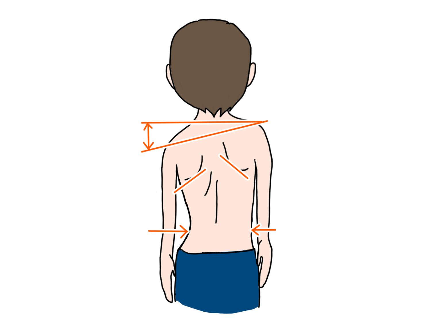 脊柱側弯症が考えられる症状