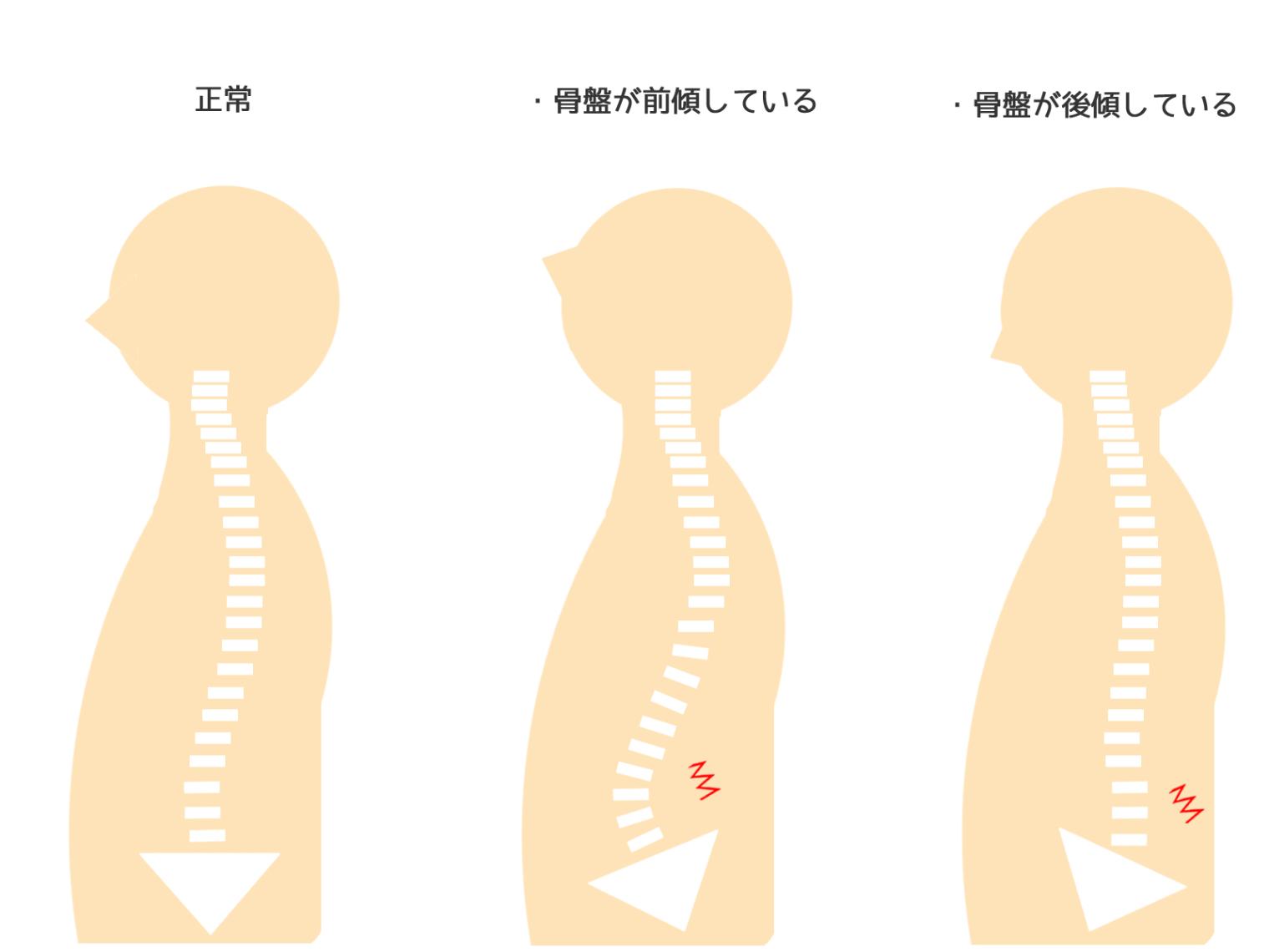 姿勢不良が考えられる症状